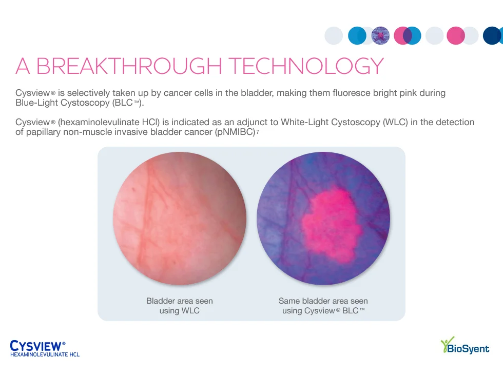 Cysview IQVIA OCE CLM slide comparing white-light and blue-light cystoscopy imaging